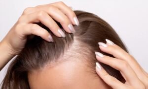 Woman with hair loss by temples