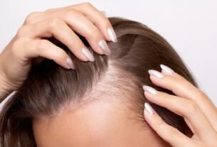 Woman with hair loss by temples